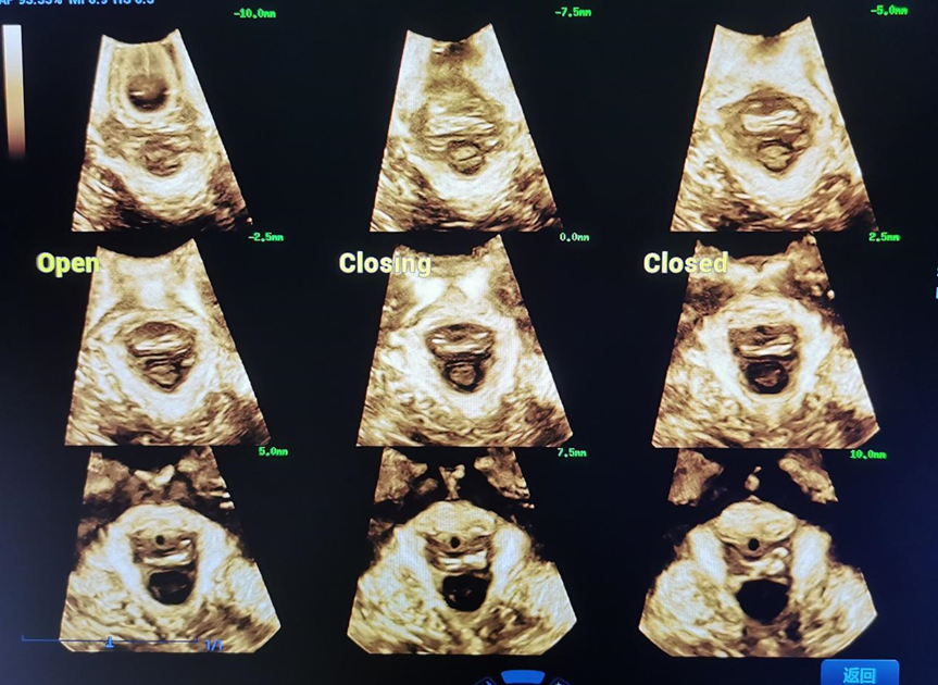 什么是超声容积探头妇科超声 ｜ 盆底超声检查技巧及标准化测量_https://www.jmylbn.com_新闻资讯_第4张