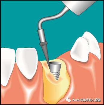 气动洁牙机怎么样卡瓦 SONICflex 气动洁牙机--多功能工作尖_https://www.jmylbn.com_新闻资讯_第34张