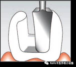 气动洁牙机怎么样卡瓦 SONICflex 气动洁牙机--多功能工作尖_https://www.jmylbn.com_新闻资讯_第98张