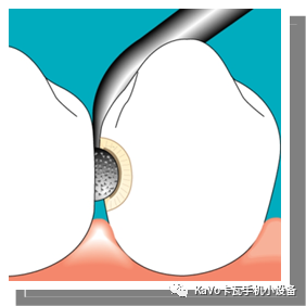 气动洁牙机怎么样卡瓦 SONICflex 气动洁牙机--多功能工作尖_https://www.jmylbn.com_新闻资讯_第57张