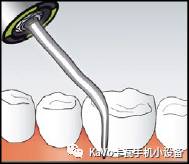 气动洁牙机怎么样卡瓦 SONICflex 气动洁牙机--多功能工作尖_https://www.jmylbn.com_新闻资讯_第13张