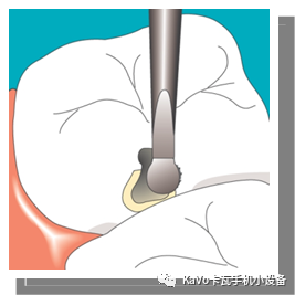 气动洁牙机怎么样卡瓦 SONICflex 气动洁牙机--多功能工作尖_https://www.jmylbn.com_新闻资讯_第52张