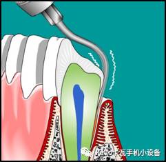 气动洁牙机怎么样卡瓦 SONICflex 气动洁牙机--多功能工作尖_https://www.jmylbn.com_新闻资讯_第25张
