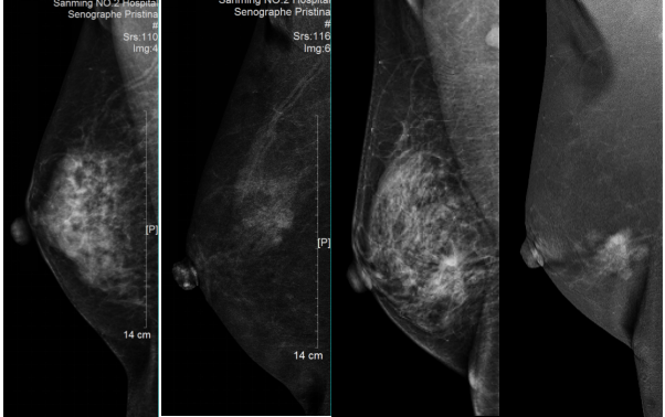 数字钼靶是什么火眼金睛，为乳守护---我院医学影像科成功开展多项数字乳腺X摄影新技术_https://www.jmylbn.com_新闻资讯_第11张