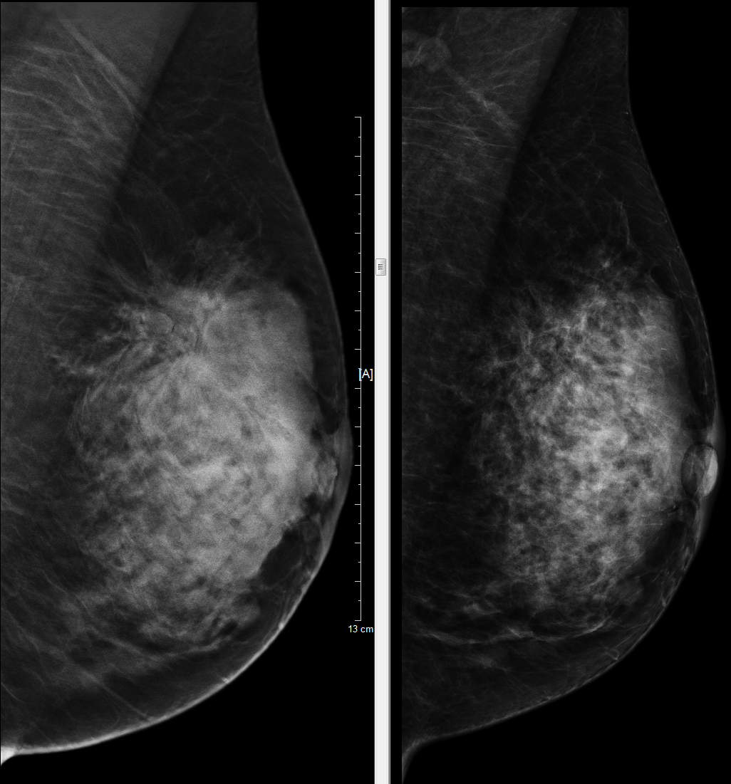 数字钼靶是什么火眼金睛，为乳守护---我院医学影像科成功开展多项数字乳腺X摄影新技术_https://www.jmylbn.com_新闻资讯_第8张