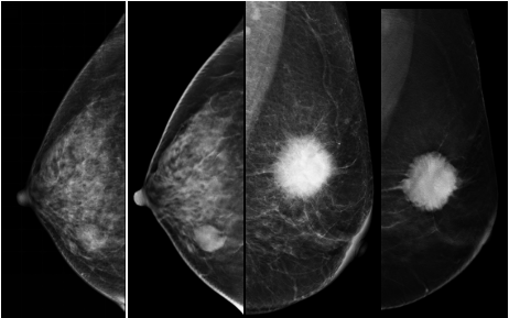 数字钼靶是什么火眼金睛，为乳守护---我院医学影像科成功开展多项数字乳腺X摄影新技术_https://www.jmylbn.com_新闻资讯_第10张