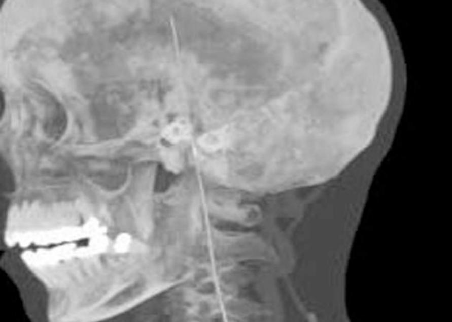 留置针怎么取出输液针断在血管里，后果可能有多严重？_https://www.jmylbn.com_新闻资讯_第2张