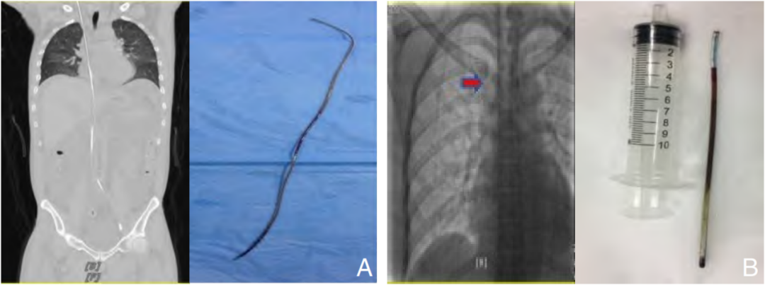 留置针怎么取出输液针断在血管里，后果可能有多严重？_https://www.jmylbn.com_新闻资讯_第3张