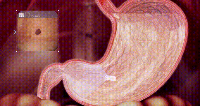 胃镜胶是什么不插管，不麻醉，吞颗“胶囊”，胶囊胃镜检查到底是一种什么样的体验？_https://www.jmylbn.com_新闻资讯_第7张