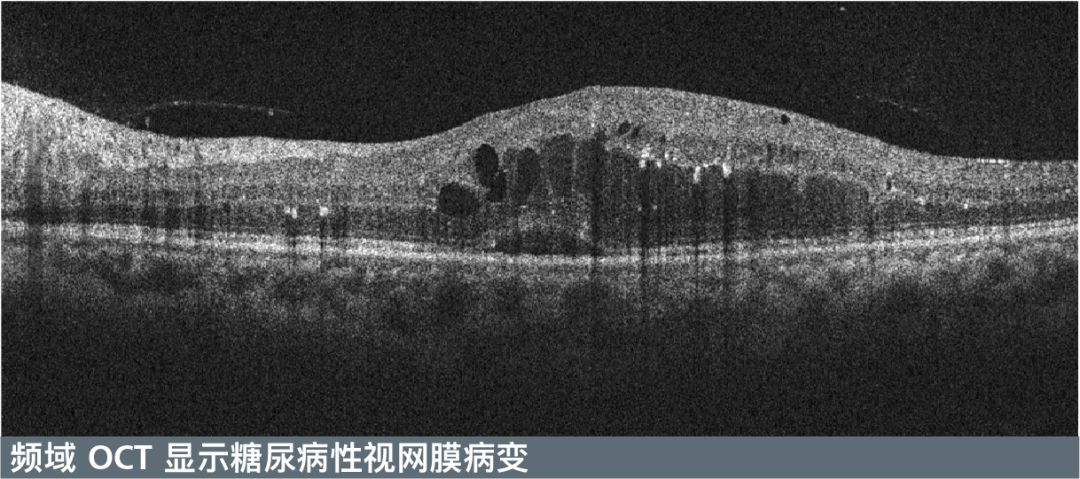 视微影像正式启动a轮融资 打造世界领先眼科影像科技 Svision 视微影像