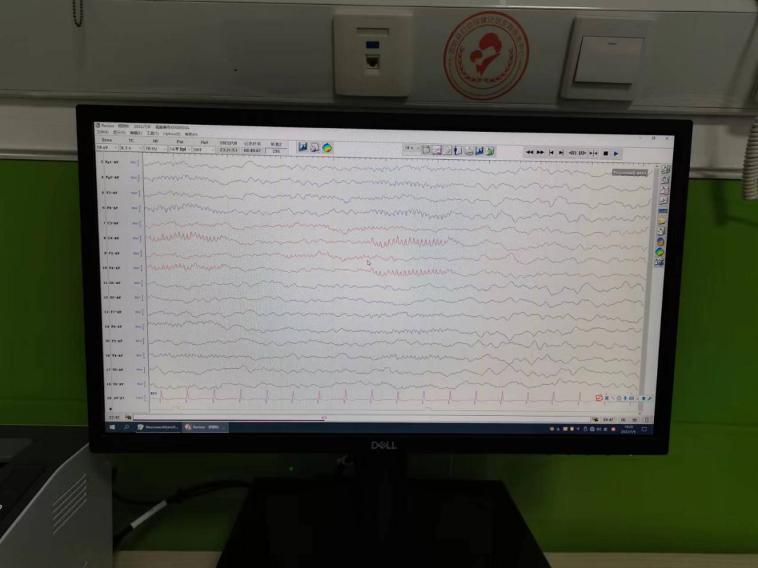 日本光电脑电图怎么样癫痫诊断的必备利器——视频脑电图_https://www.jmylbn.com_新闻资讯_第4张