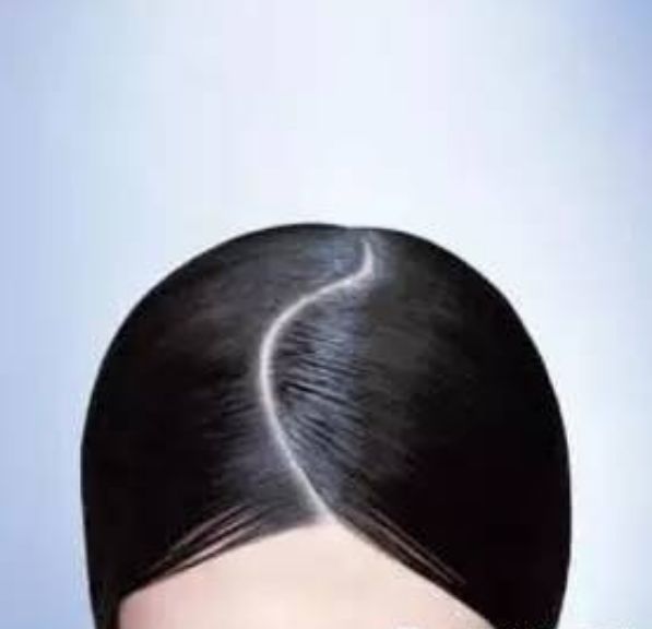 白头发与头皮健康有什么关联？