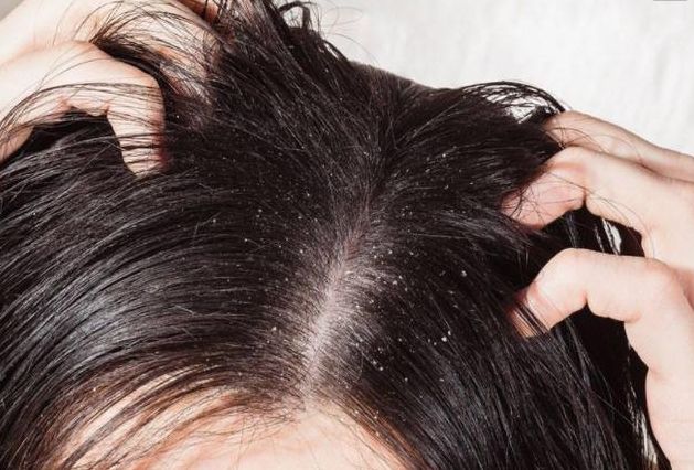 经常抠头皮危害大！