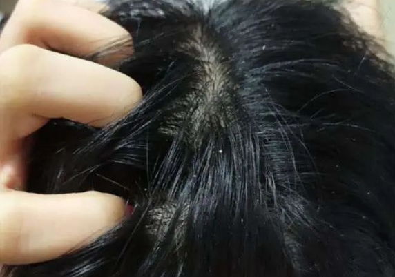 为什么头皮总是长小疙瘩？主要跟你一直在做的这个3因素有关！