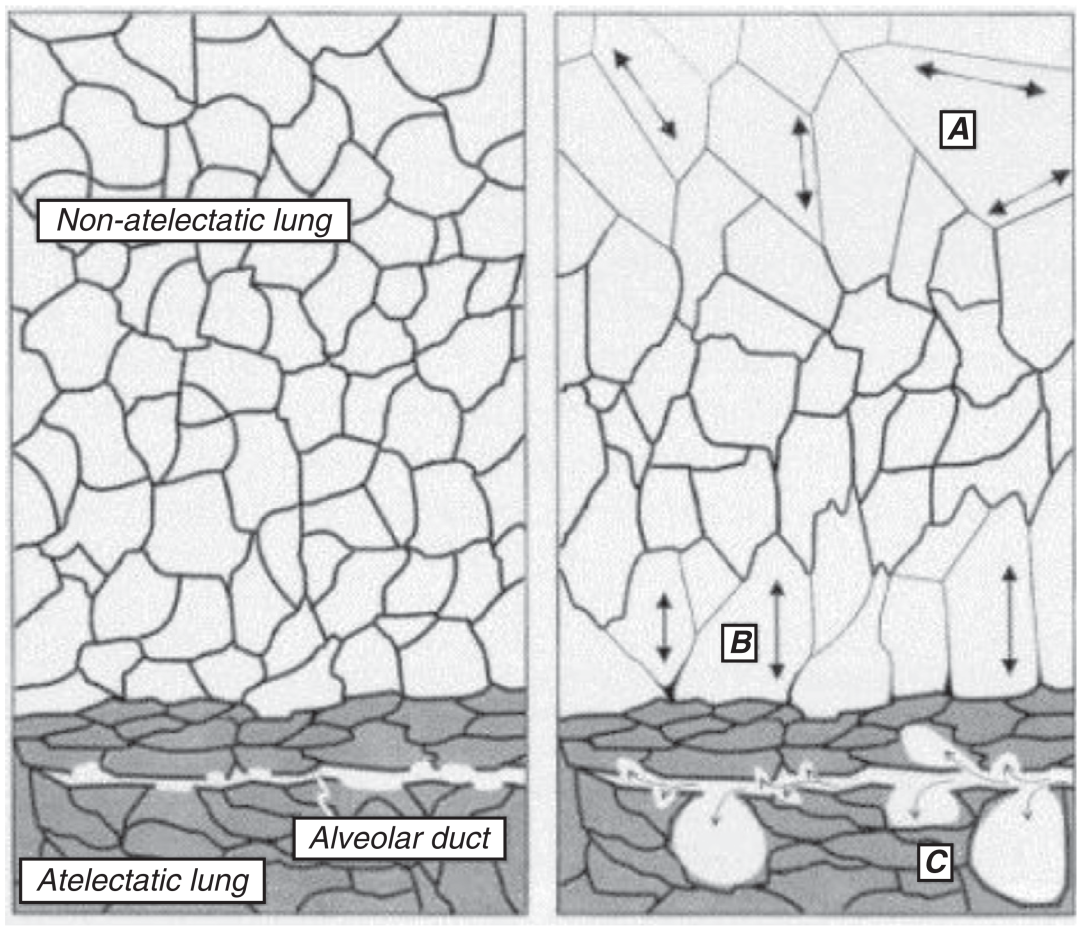 med压力怎么弄急性呼吸窘迫综合征呼气末正压设定_https://www.jmylbn.com_新闻资讯_第1张