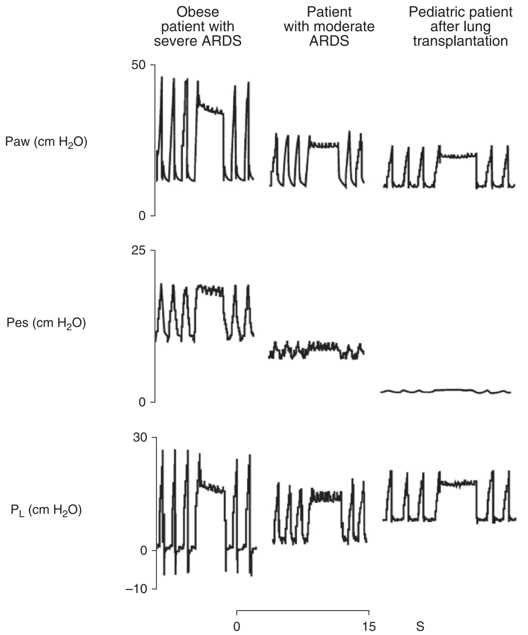 med压力怎么弄急性呼吸窘迫综合征呼气末正压设定_https://www.jmylbn.com_新闻资讯_第5张