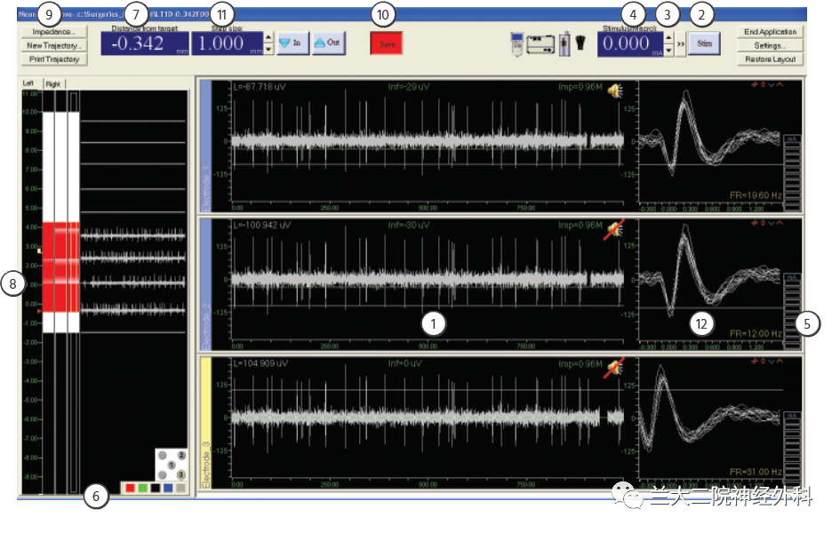 手电极怎么用【设备】兰大二院神经外科应用多通道微电极电生理记录技术辅助帕金森病DBS手术_https://www.jmylbn.com_新闻资讯_第4张