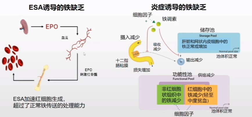 由於鐵缺乏和代謝障礙(圖2),ckd患者合併腎性貧血的人群非常廣泛.