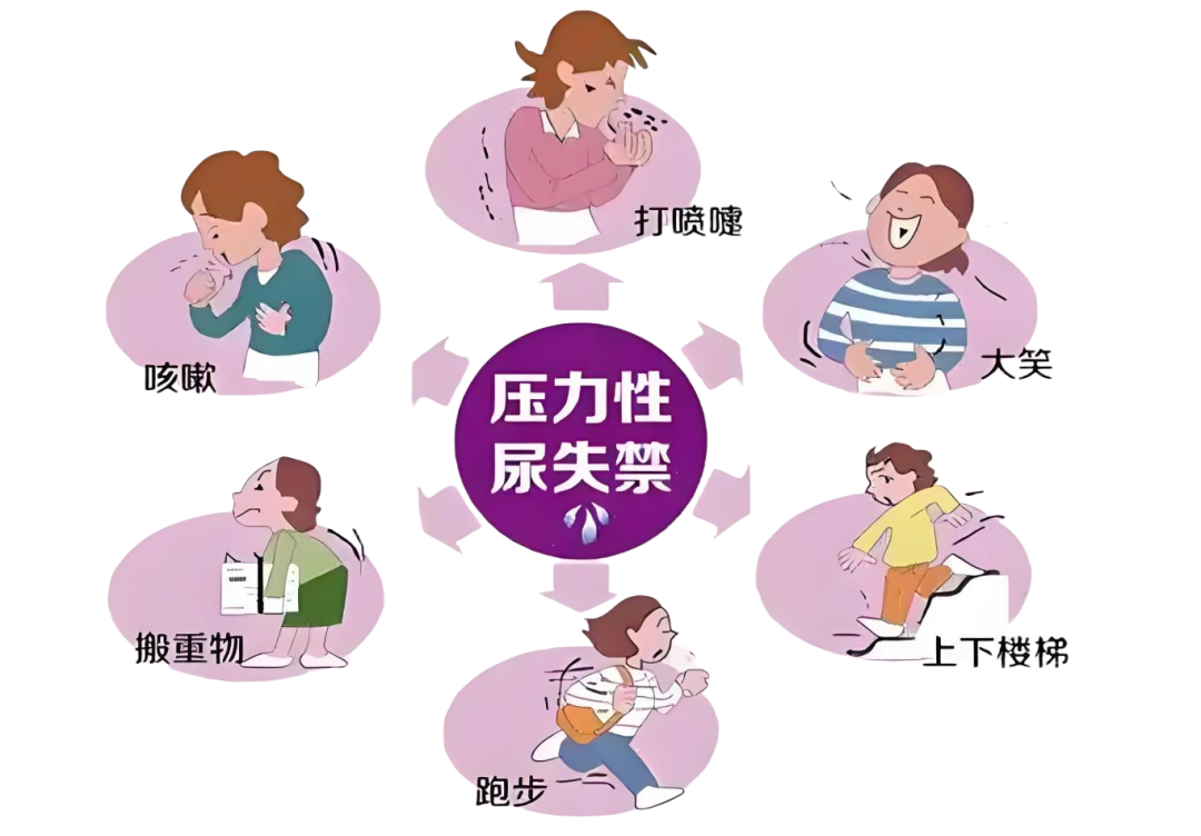 尿道张力过强怎么尿失禁不再尴尬，我院成功开展经闭孔无张力尿道中段悬吊术（TVT-O）_https://www.jmylbn.com_新闻资讯_第9张