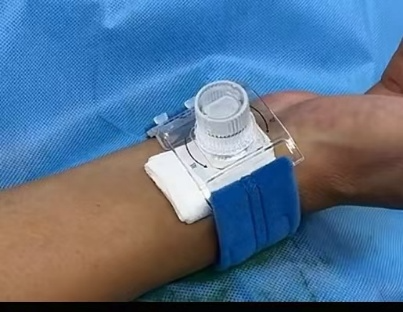 桡动脉鞘怎么读动脉鞘管拔除后按压要点荟萃_https://www.jmylbn.com_新闻资讯_第4张