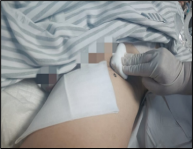 桡动脉鞘怎么读动脉鞘管拔除后按压要点荟萃_https://www.jmylbn.com_新闻资讯_第2张