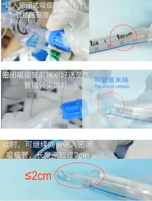 为什么使用密闭式吸痰管如何规范进行密闭式吸痰？这些内容说的很清楚！_https://www.jmylbn.com_新闻资讯_第2张