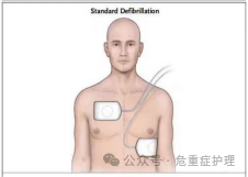 除颤仪什么情况下使用救命神器——除颤仪的使用与维护一文全搞定！_https://www.jmylbn.com_新闻资讯_第23张