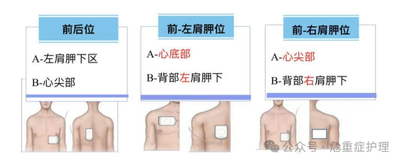 除颤仪什么情况下使用救命神器——除颤仪的使用与维护一文全搞定！_https://www.jmylbn.com_新闻资讯_第24张