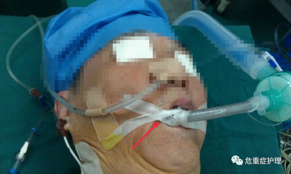 弹力绷带怎么固定有图有真相，手把手教您气管插管固定新方式！_https://www.jmylbn.com_新闻资讯_第3张