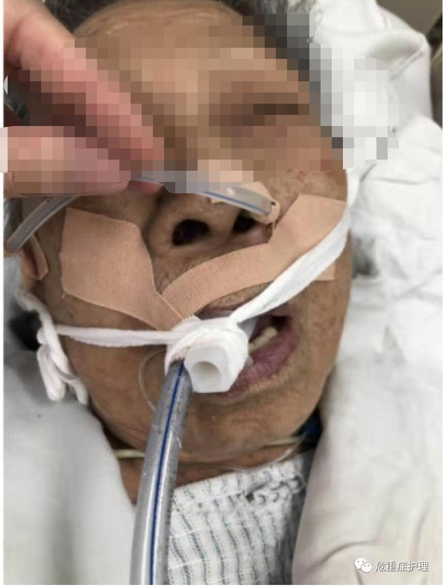 弹力绷带怎么固定有图有真相，手把手教您气管插管固定新方式！_https://www.jmylbn.com_新闻资讯_第4张