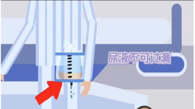 输尿管导管是什么留置导尿管，这些知识你必须知道！_https://www.jmylbn.com_新闻资讯_第18张
