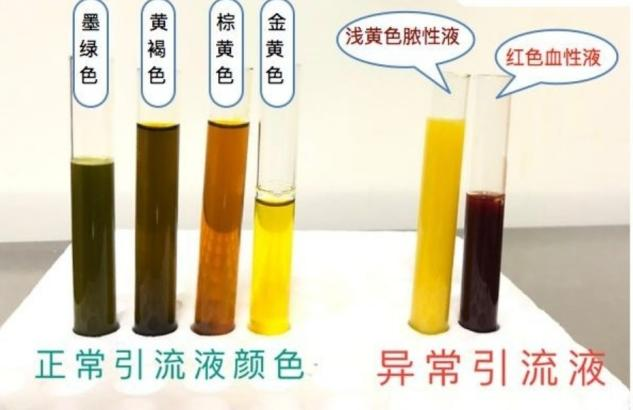 伤口引流袋怎么用胆道术后T管带回家，应该如何护理？_https://www.jmylbn.com_新闻资讯_第4张