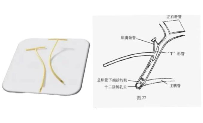 伤口引流袋怎么用胆道术后T管带回家，应该如何护理？_https://www.jmylbn.com_新闻资讯_第1张