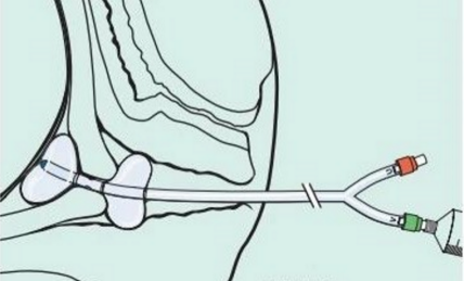 cook球囊怎么取孕12 周隐瞒“伤心事”致引产！备孕这项检查有多重要！？_https://www.jmylbn.com_新闻资讯_第7张