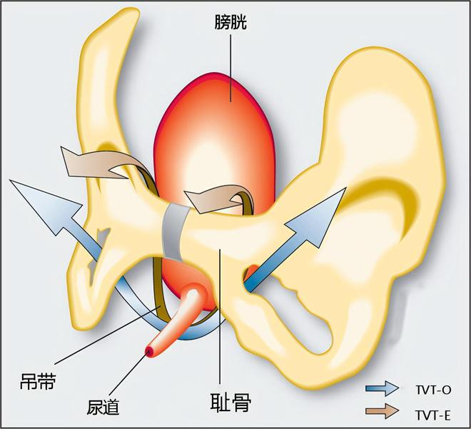 尿道张力过强怎么回事【技术分享】晋江二院经阴道无张力尿道中段吊带术治疗女性压力性尿失禁_https://www.jmylbn.com_新闻资讯_第3张