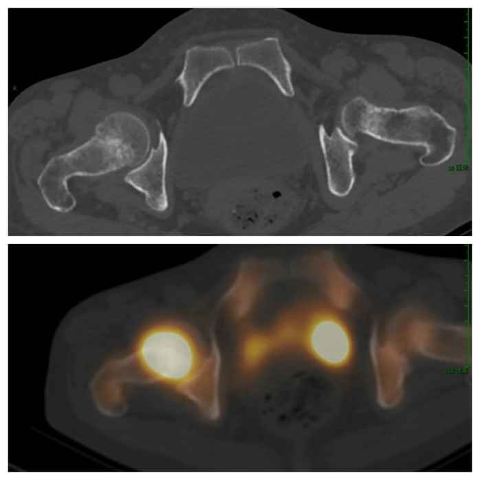d-spect怎么检查【核医学科普】SPECT-CT全身骨显像wholebody bone scan给全身骨骼拍张“艺术照”_https://www.jmylbn.com_新闻资讯_第24张