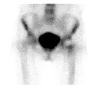 d-spect怎么检查【核医学科普】SPECT-CT全身骨显像wholebody bone scan给全身骨骼拍张“艺术照”_https://www.jmylbn.com_新闻资讯_第27张