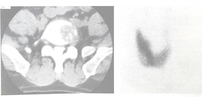 d-spect怎么检查【核医学科普】SPECT-CT全身骨显像wholebody bone scan给全身骨骼拍张“艺术照”_https://www.jmylbn.com_新闻资讯_第17张