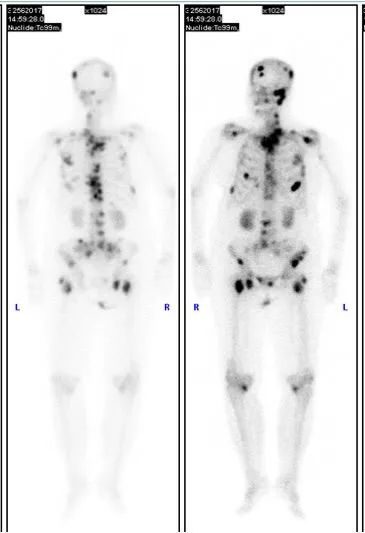 d-spect怎么检查【核医学科普】SPECT-CT全身骨显像wholebody bone scan给全身骨骼拍张“艺术照”_https://www.jmylbn.com_新闻资讯_第21张
