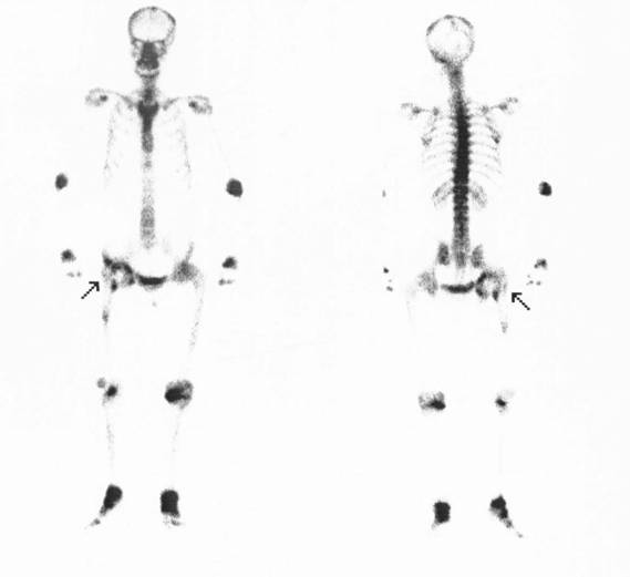 d-spect怎么检查【核医学科普】SPECT-CT全身骨显像wholebody bone scan给全身骨骼拍张“艺术照”_https://www.jmylbn.com_新闻资讯_第28张