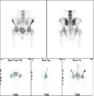 d-spect怎么检查【核医学科普】SPECT-CT全身骨显像wholebody bone scan给全身骨骼拍张“艺术照”_https://www.jmylbn.com_新闻资讯_第26张
