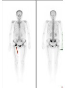 d-spect怎么检查【核医学科普】SPECT-CT全身骨显像wholebody bone scan给全身骨骼拍张“艺术照”_https://www.jmylbn.com_新闻资讯_第25张