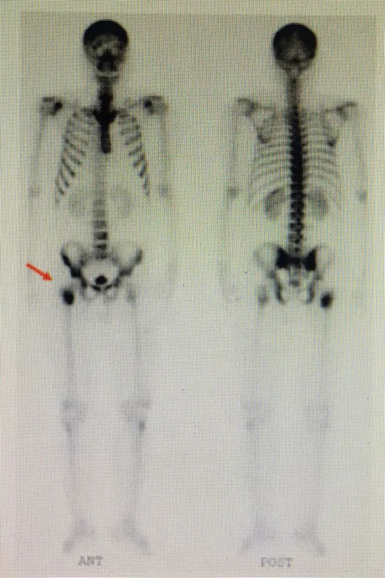 d-spect怎么检查【核医学科普】SPECT-CT全身骨显像wholebody bone scan给全身骨骼拍张“艺术照”_https://www.jmylbn.com_新闻资讯_第23张