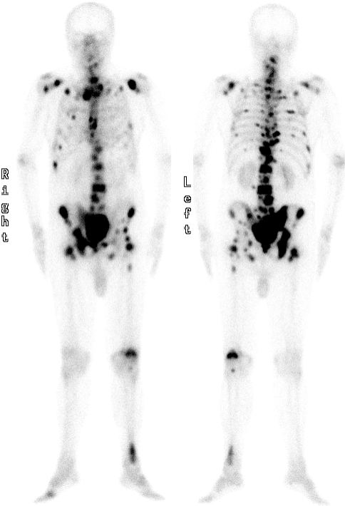 d-spect怎么检查【核医学科普】SPECT-CT全身骨显像wholebody bone scan给全身骨骼拍张“艺术照”_https://www.jmylbn.com_新闻资讯_第19张