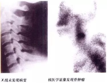 d-spect怎么检查【核医学科普】SPECT-CT全身骨显像wholebody bone scan给全身骨骼拍张“艺术照”_https://www.jmylbn.com_新闻资讯_第16张