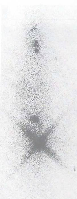 d-spect怎么检查【核医学科普】SPECT-CT全身骨显像wholebody bone scan给全身骨骼拍张“艺术照”_https://www.jmylbn.com_新闻资讯_第18张