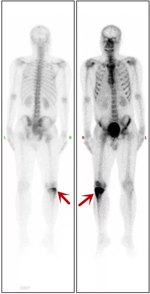 d-spect怎么检查【核医学科普】SPECT-CT全身骨显像wholebody bone scan给全身骨骼拍张“艺术照”_https://www.jmylbn.com_新闻资讯_第20张