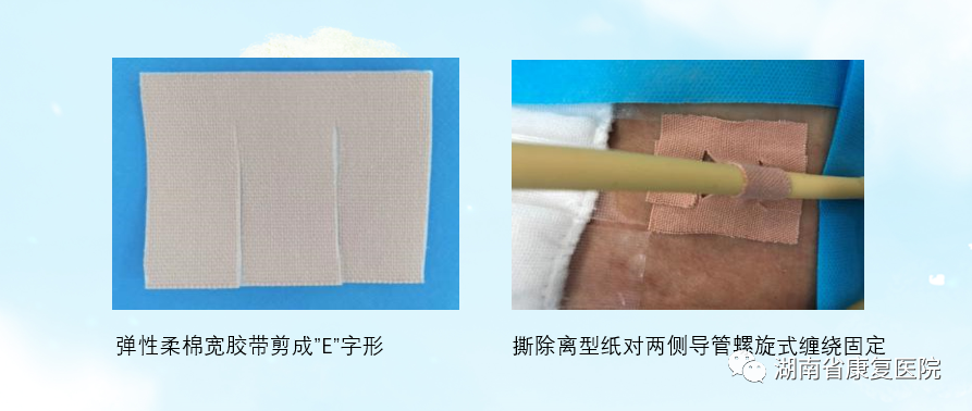 体表导管固定怎么使用用心呵护 “管”定安全——巧用弹性柔棉宽胶带制作导管固定贴_https://www.jmylbn.com_新闻资讯_第5张
