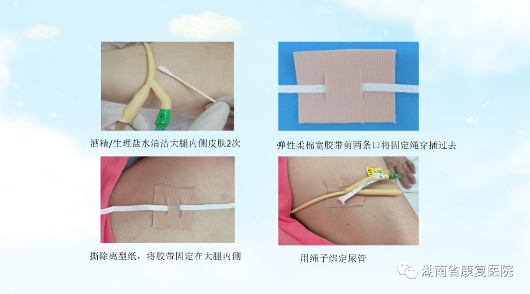 体表导管固定怎么使用用心呵护 “管”定安全——巧用弹性柔棉宽胶带制作导管固定贴_https://www.jmylbn.com_新闻资讯_第3张