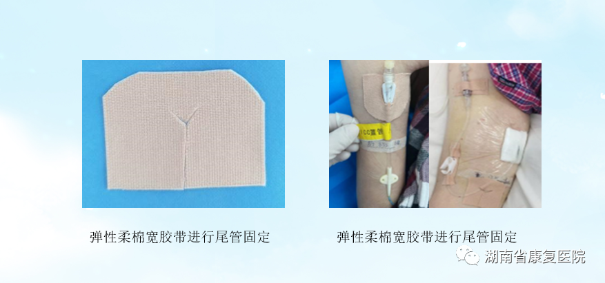 体表导管固定怎么使用用心呵护 “管”定安全——巧用弹性柔棉宽胶带制作导管固定贴_https://www.jmylbn.com_新闻资讯_第4张